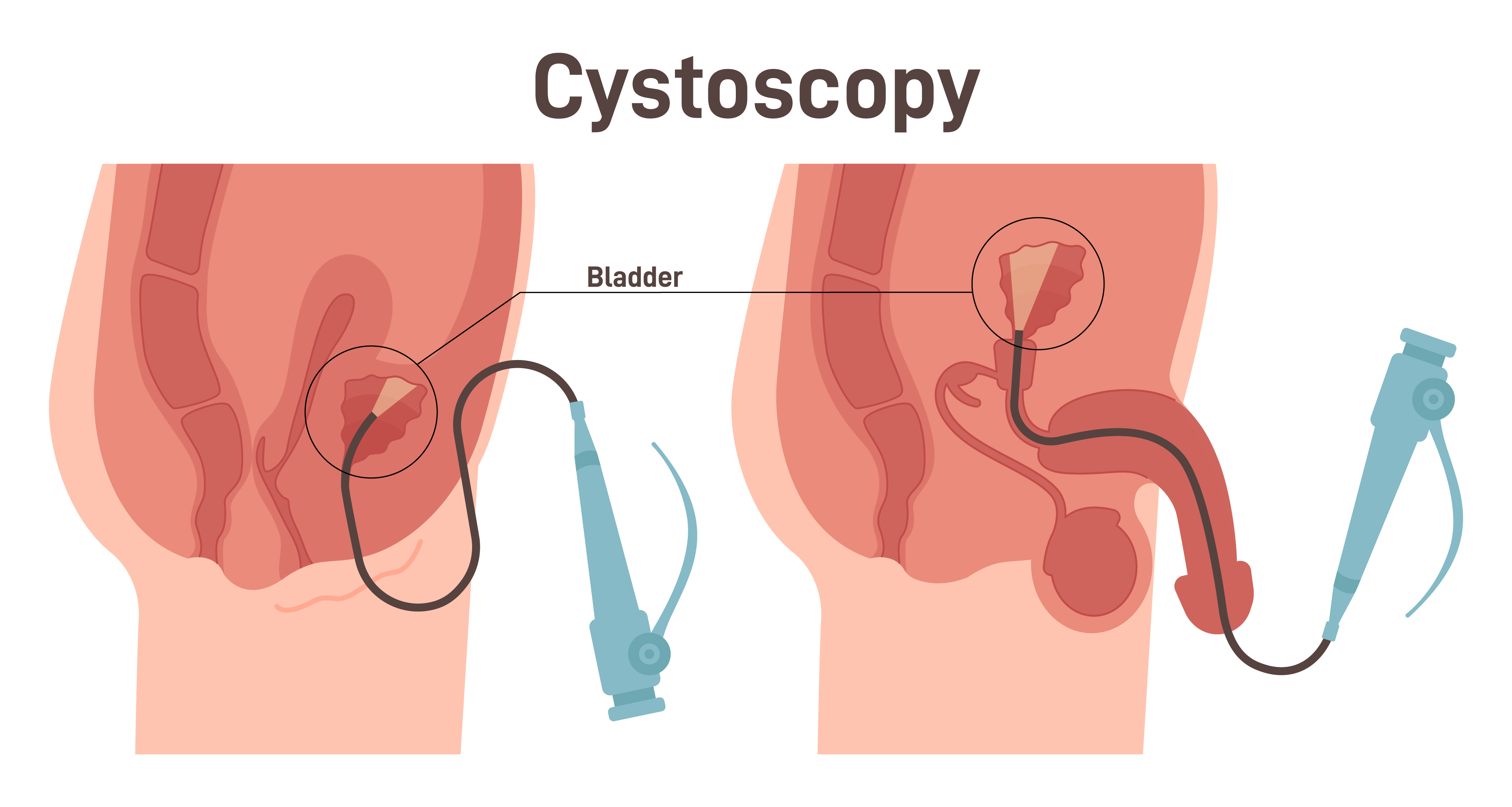 การส่องกล้องตรวจกระเพาะปัสสาวะ Cystoscope ,ส่องกล้องท่อปัสสาวะ , ส่องกล้องทางเดินปัสสาวะ , ตรวจกระเพาะปัสสาวะ