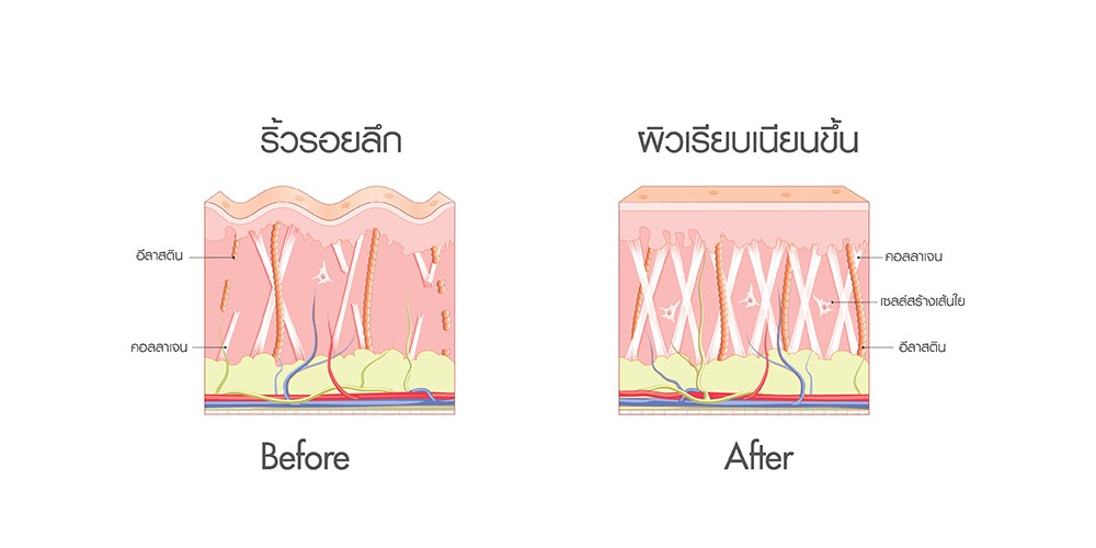 REJURAN , รีจูรัน 