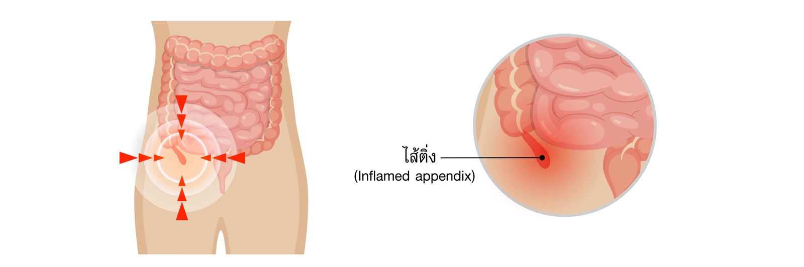 #Appendectomy #ไส้ติ่งอักเสบ