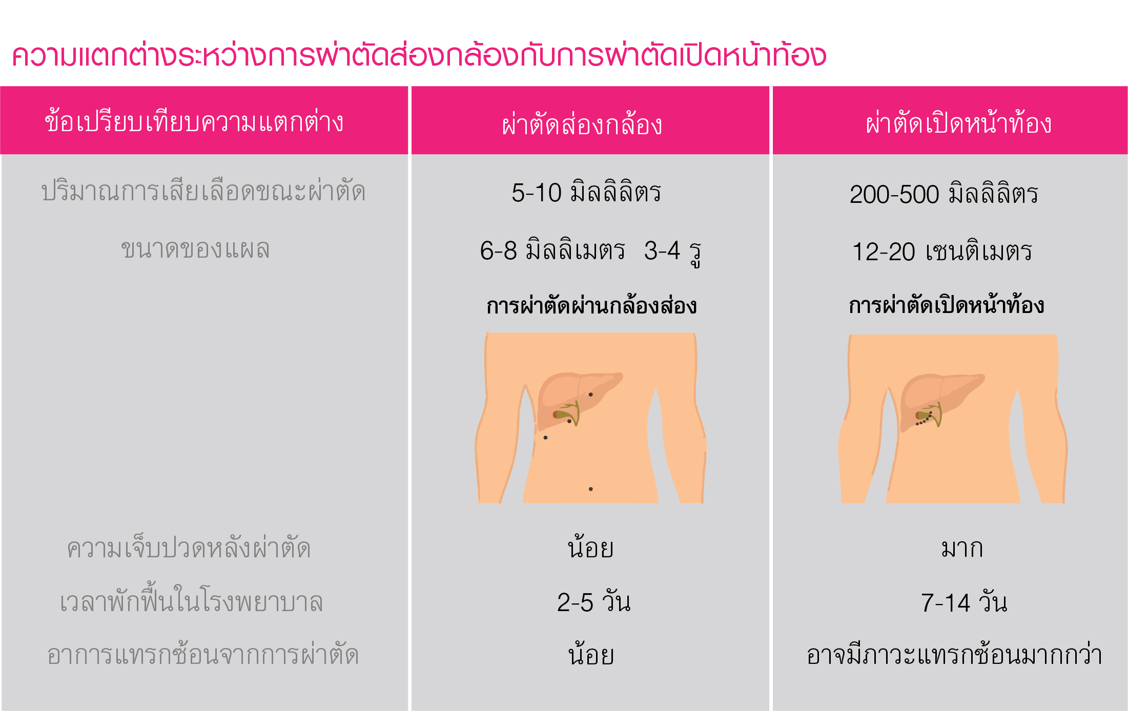 ผ่าตัดส่องกล้องนิ่วในถุงน้ำดี, ผ่าตัดผ่านกล้อง, 
นิ่วในถุงน้ำดี,ผ่าตัดแผลเล็ก, Laparoscopic Surgery, Laparoscope, Laparoscopic Cholecystectomy, Minimal Invasive Surgery, LC ,Open Cholecystectomy