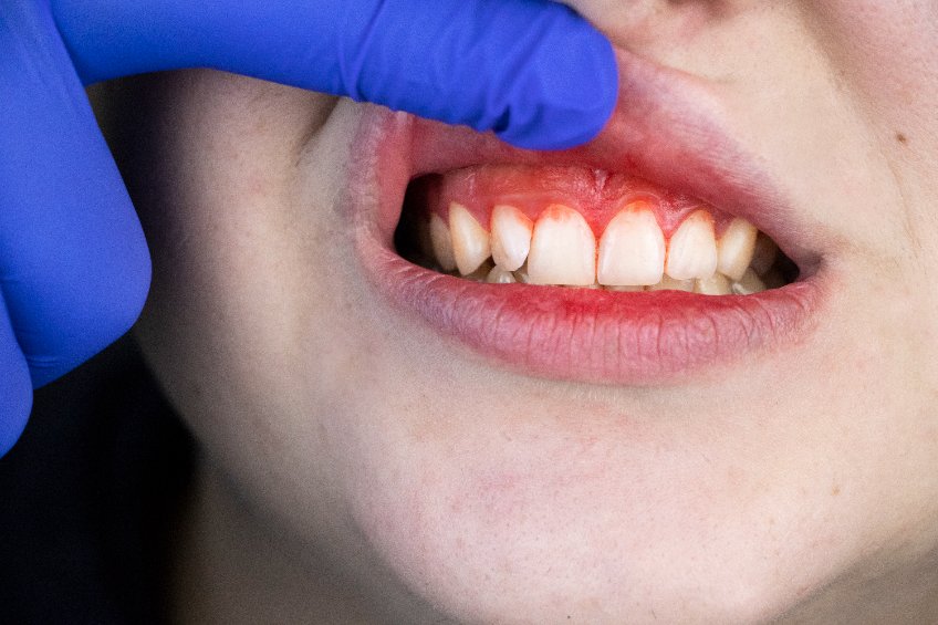 สาเหตุที่ทำให้มีอาการปวดฟัน คือ โรคปริทันต์ และโรคฟันผุ