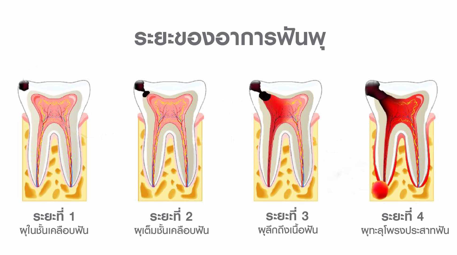 อาการปวดฟัน สามารถรักษาให้หายได้